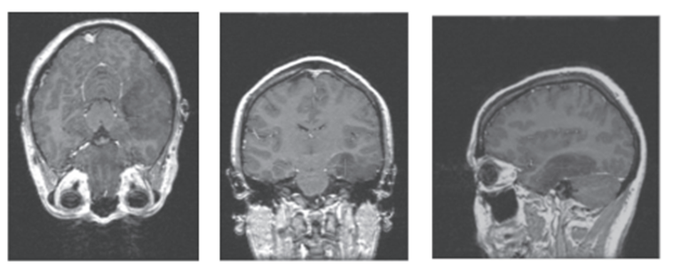Perpendicular views of brain MRI in which it is possible to observe Rician noise, low contrast between lobular structures and the anaplasic astrocytoma (Red cross).