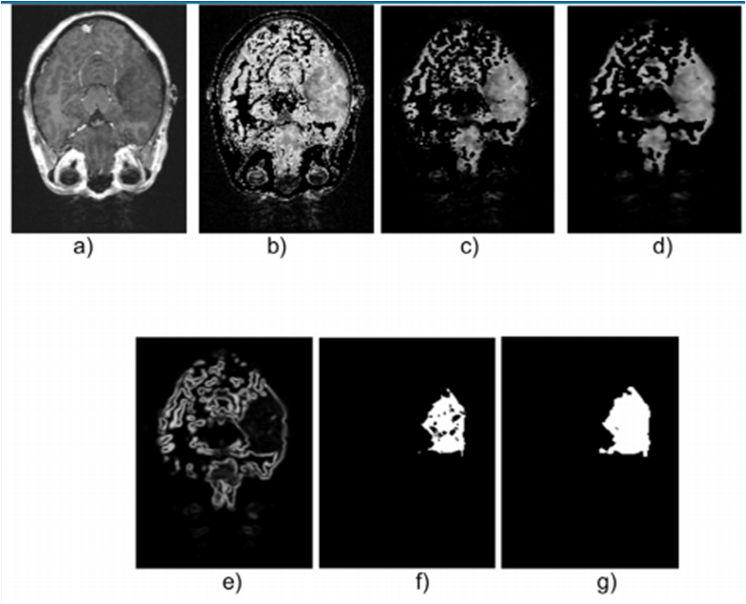 Axial view of images belonging to DB1: a) Original, b) Thresholdized, c) Erode, d) Smoothed with median filter, e) Borders with gradient magnitude, f) Segmented with region growing technique, g) HGG Dilated.