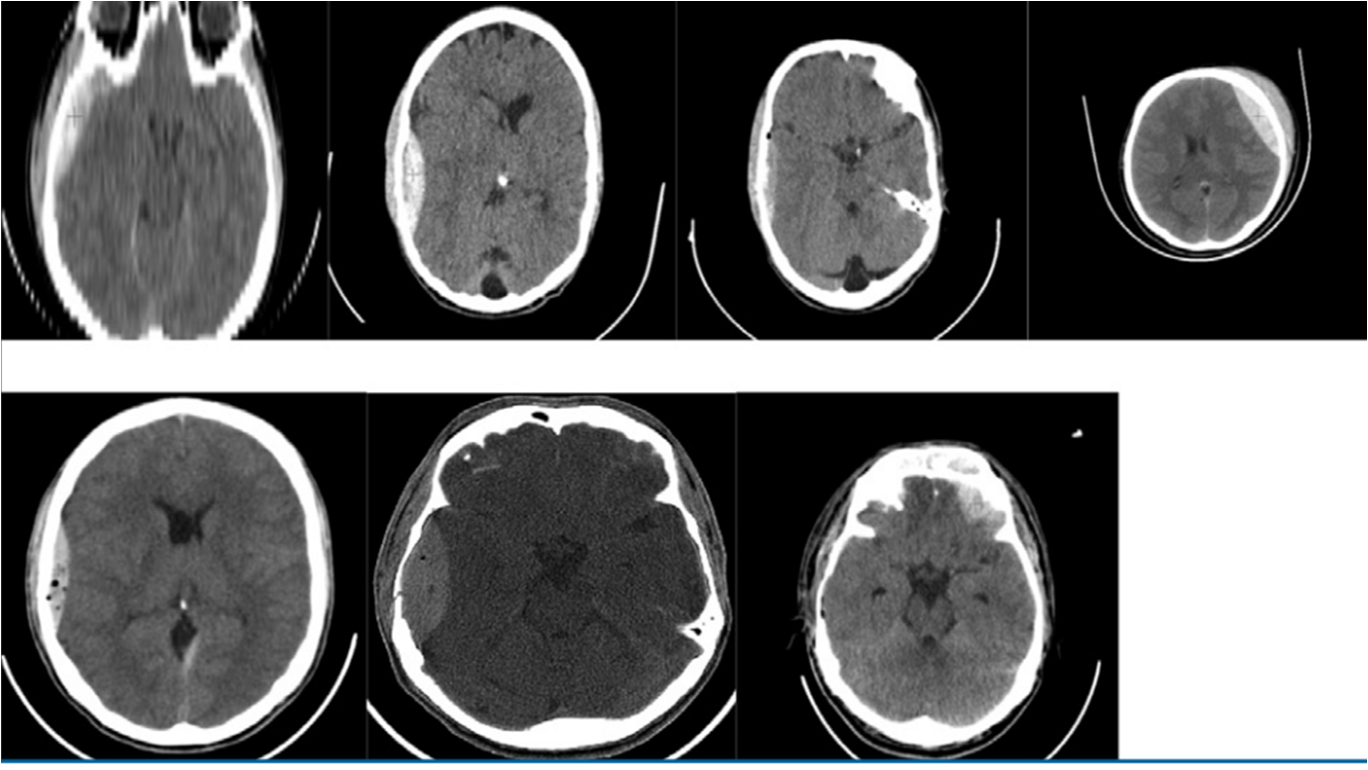 A red cross pinpoints the EDH in each of the databases considered, Imperfections (noise + artifact) are also seen in cerebral MSCT images