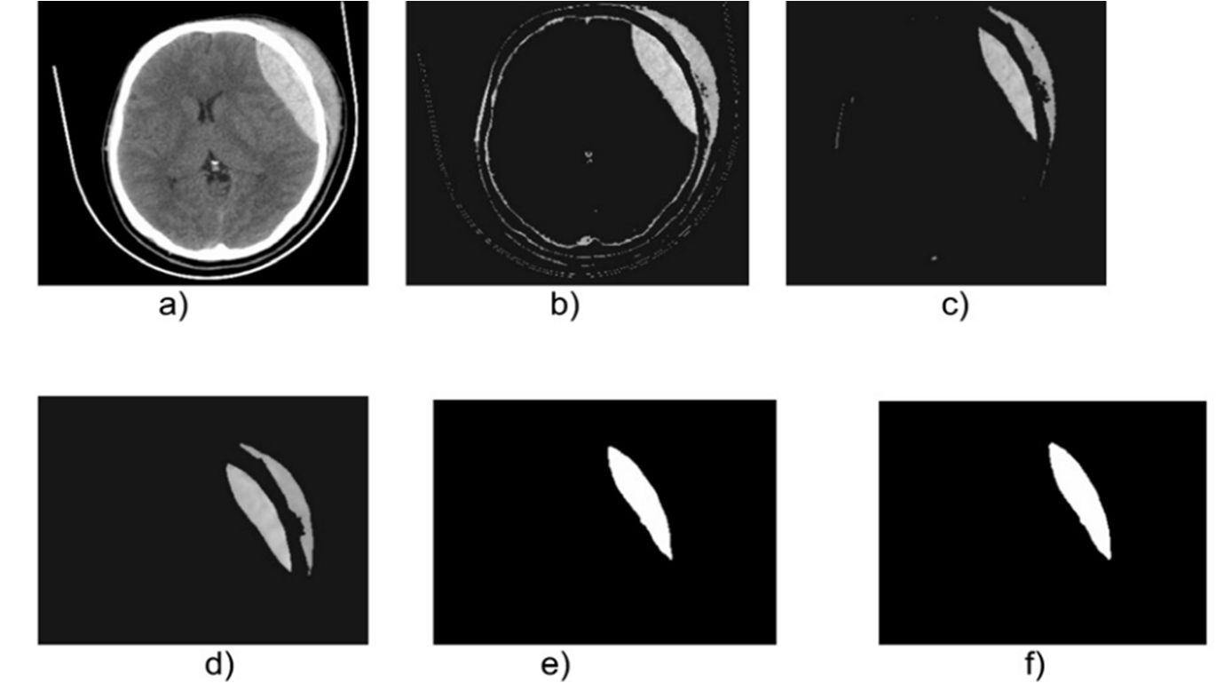 Cross-sectional view of images belonging to the database identified as DB1: a) Original, b) Thresholdized, c) Eroded, d) Median, e) Segmented, f) Postprocessed with the binary morphological dilation filter.