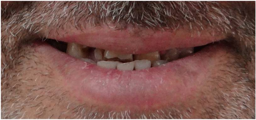 Smile view of the patient