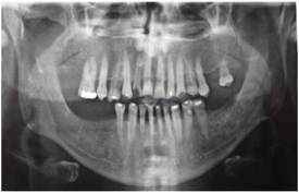 Pre-treatment panoramic radiograph