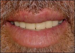 Smile view with interim restorations in new VD