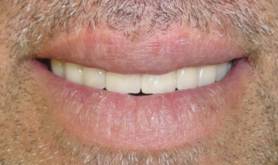 Smile view with final restorati