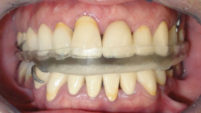 Hard occlusal splint to prevent nocturnal parafunctional occlusal wear