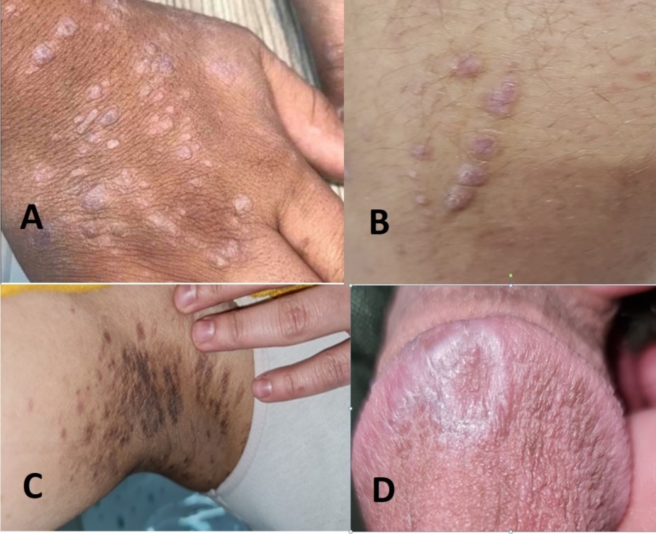 (A) classical type of lichen planus on the dorsum of hand. (B) Koebner phenomenon of hypertrophic lichen planus on the lower leg. (C) Lichen planus pigmentosus on axillae. (D) Annular type of lichen planus on glanus penus