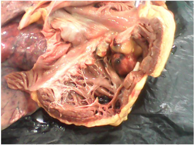Vista de la cavidad ventricular derecha en la
que destaca masa de aspecto tumoral amarillo rojiza multilobulada.