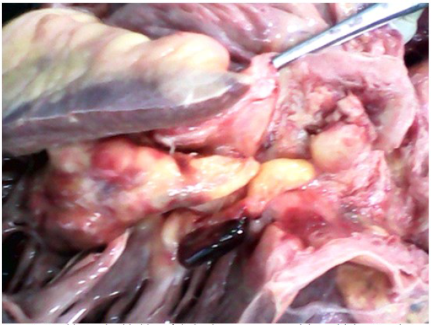Vista del tracto de salida del ventr&iacute;culo
derecho con engrosamiento de la pared de la arteria pulmonar como consecuencia
de la infiltraci&oacute;n tumoral.