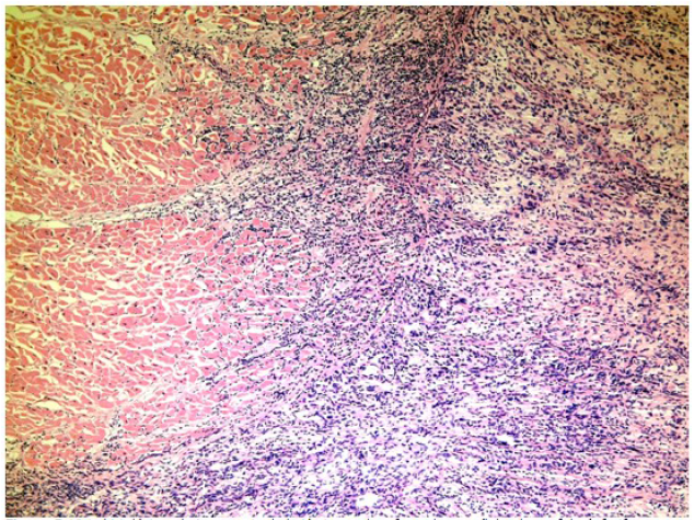 Vista histol&oacute;gica a bajo aumento de lesi&oacute;n
tumoral conformada por c&eacute;lulas de morfolog&iacute;a fusiforme con atipia e
infiltraci&oacute;n mioc&aacute;rdica. (Coloraci&oacute;n de hematoxilina-eosina)