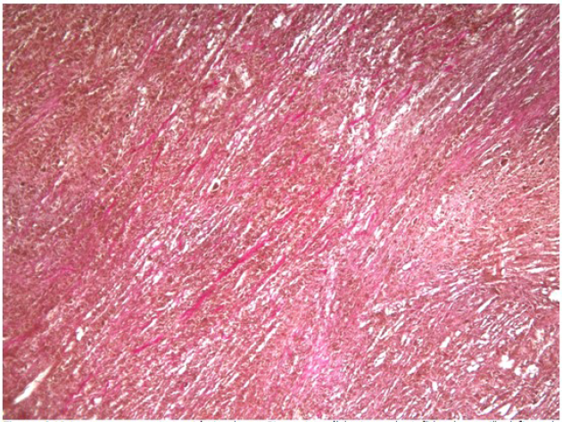 Vista a menor aumento con t&eacute;cnica de van
Gieson. Las c&eacute;lulas tumorales te&ntilde;idas de amarillo definen el origen muscular
liso de la lesi&oacute;n.