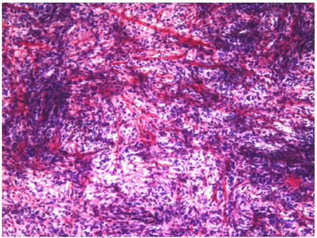 T&eacute;cnica de hematoxilina fosfot&uacute;gstica de
Mallory. Los n&uacute;cleos se ti&ntilde;en de azul y el col&aacute;geno de rojo. No se identifican
fibras azules de origen muscular estriado. (40 X)