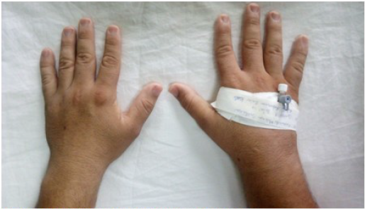 Inflamaci&oacute;n de la articulaci&oacute;n de la mu&ntilde;eca derecha.