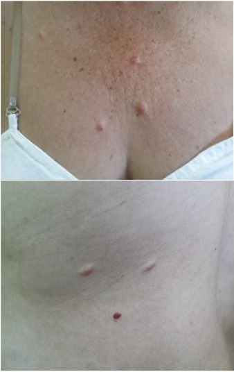 Imágenes donde se muestran las lesiones en tórax y espalda.