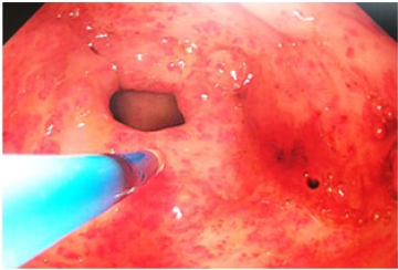 Lesiones endosc&oacute;picas milim&eacute;tricas a nivel de antro g&aacute;strico de aspecto vascular arboriforme correspondientes con ectasias vasculares.