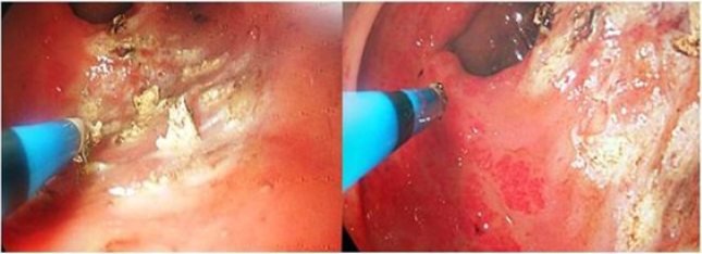 Tratamiento endosc&oacute;pico con coagulaci&oacute;n con arg&oacute;n plasma.