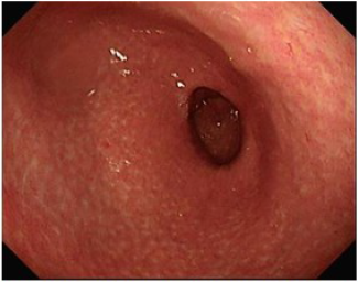 Imagen de antro g&aacute;strico de la paciente posterior a 4 secciones de tratamiento endosc&oacute;pico de coagulaci&oacute;n con arg&oacute;n plasma Se observa una mucosa con m&uacute;ltiples lesiones blanquecinas de aspecto cicatrizal en antro g&aacute;strico sin evidencias de las lesiones vasculares reportadas