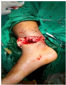 Imagen que muestra la fractura abierta.