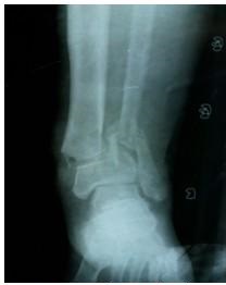Imagen radiográfica que muestra la fractura del pilón tibial en vista AP.