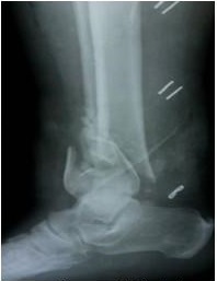 Imagen radiográfica que muestra la fractura del pilón tibial en vista L.