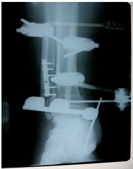 Imagen radiográfica que muestra la fijación y técnica aplicada.