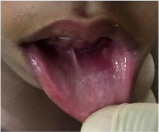Vesculas en labio superior y fondo del surco vestibular derecho e izquierdo del labio inferior.