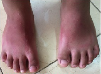 Exantema en el dorso de los pies.