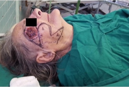 - Dise&ntilde;o del colgajo