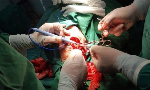 - Incisi&oacute;n y ex&eacute;resis de la masa tumoral