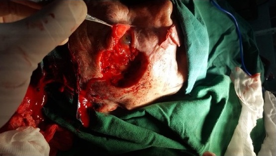 - Liberaci&oacute;n del ligamento palpebral lateral y decolado del tejido.