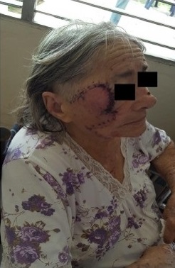 - Retirada de puntos alternos al s&eacute;ptimo d&iacute;a