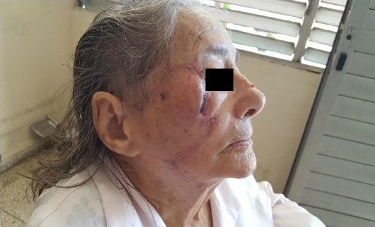 - Retirada de todos los puntos al octavo d&iacute;a