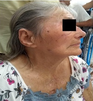 - Resultado final despu&eacute;s de un mes de operada