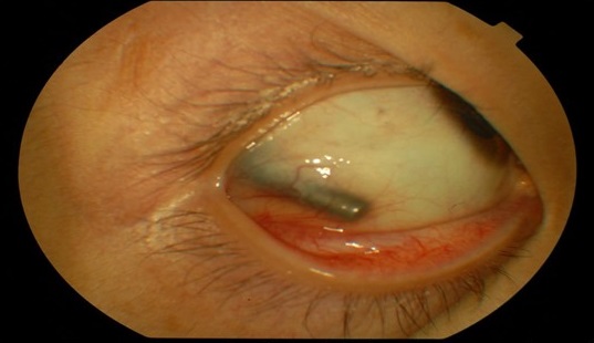 - Imagen que muestra masa alargada, fina, de bordes regulares y romos, color oscuro, dura a la palpación en el cuadrante ínfero de la conjuntiva bulbar