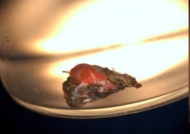 - Masa engrosada, de color oscuro, con brillo metálico, vascularizada, irregular y de aspecto fibrovascular que se encontraba adyacente al cuerpo extraño