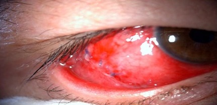 - Sutura con seda 8-0, después de extraído el cuerpo extraño y tejido adyacente.