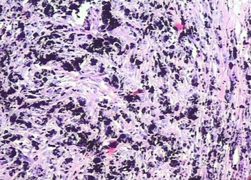 - Tejido fibroso con pigmento pardo oscuro presente en la totalidad de la muestra examinada.