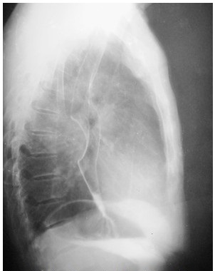 - Radiograf&iacute;a contrastada de es&oacute;fago, est&oacute;mago y duodeno. Compresi&oacute;n esof&aacute;gica extr&iacute;nseca en tercio medio que desplaza hacia adelante el &oacute;rgano. Se conserva integridad de la mucosa esof&aacute;gica.