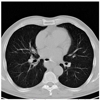 - Tomograf&iacute;a axial computarizada confirm&oacute; masa tumoral bien demarcada, con atenuaci&oacute;n homog&eacute;nea en el mediastino posterior.