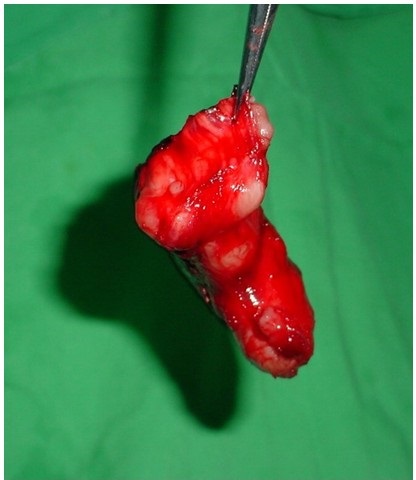 - Apariencia macrosc&oacute;pica del tumor ya resecado, el&aacute;stico y polilobulado (10x6x5 cm).