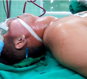 - Paciente en decúbito supino. Se observa aumento de volumen de la parte anterior del cuello, sobre todo del lóbulo derecho.