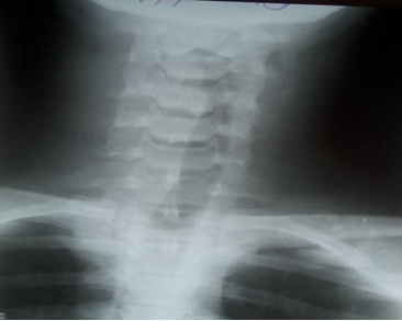 - Radiografía anteroposterior de la columna cervical, se observa desviación de la luz del esófago hacia la izquierda.