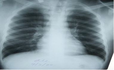 - Radiografía anteroposterior de tórax evidenció ensanchamiento del mediastino superior.