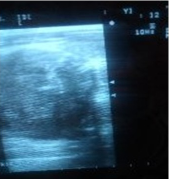 - Ultrasonido de cuello: Lóbulo derecho aumentado de volumen con el aspecto de un hematoma intraglandular.