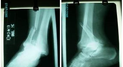 - Imagen de rayos X antero posterior y lateral del tobillo, donde se observa fractura suprasindesmal del peroné, lesión sindesmal, lesión del ligamento deltoideo y fractura del reborde antero externo del pilón tibial.