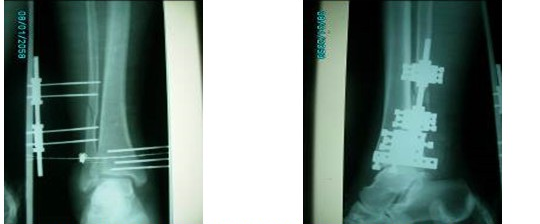 - Imágenes de rayos X anteroposterior y lateral del tobillo que muestran el aspecto interno de la reducción y fijación.