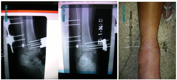 - Imágenes tomadas a los treinta días de la cirugía. Se muestran radiografías oblicua y anteroposterior del tobillo afectado y el aspecto del mismo con el fijador colocado.