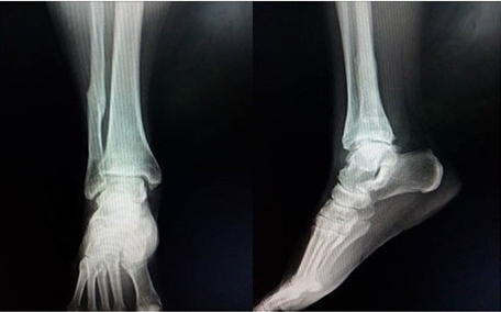 - Radiografías anteroposterior y lateral del tobillo a los cinco años de la cirugía.