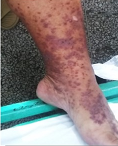 Miembro inferior derecho durante el primer ingreso.