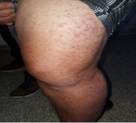 Lesiones residuales en miembro inferior izquierdo y edema nefr&oacute;tico asociado (segundo ingreso) ingreso.