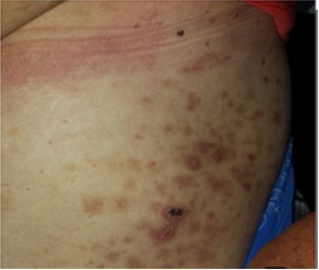 Lesiones residuales en tronco (segundo ingreso) ingreso.